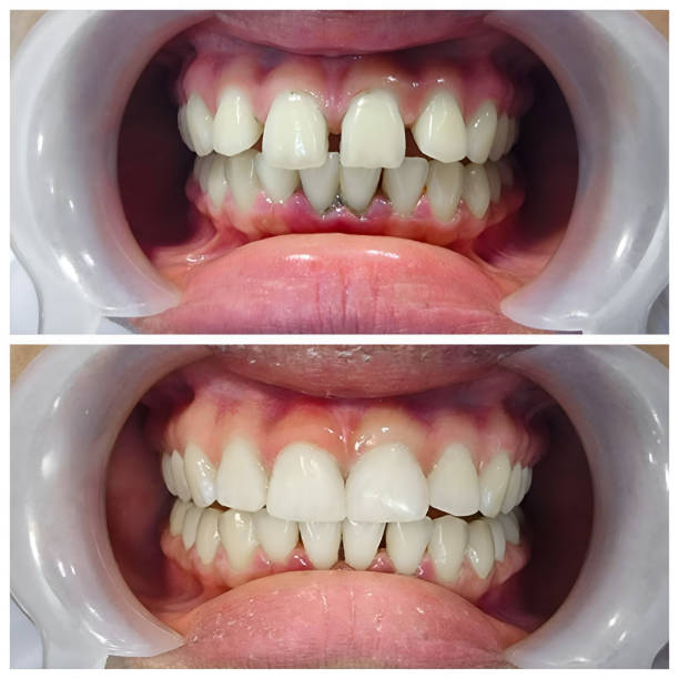 Full Mouth Reconstruction in Milam, TX